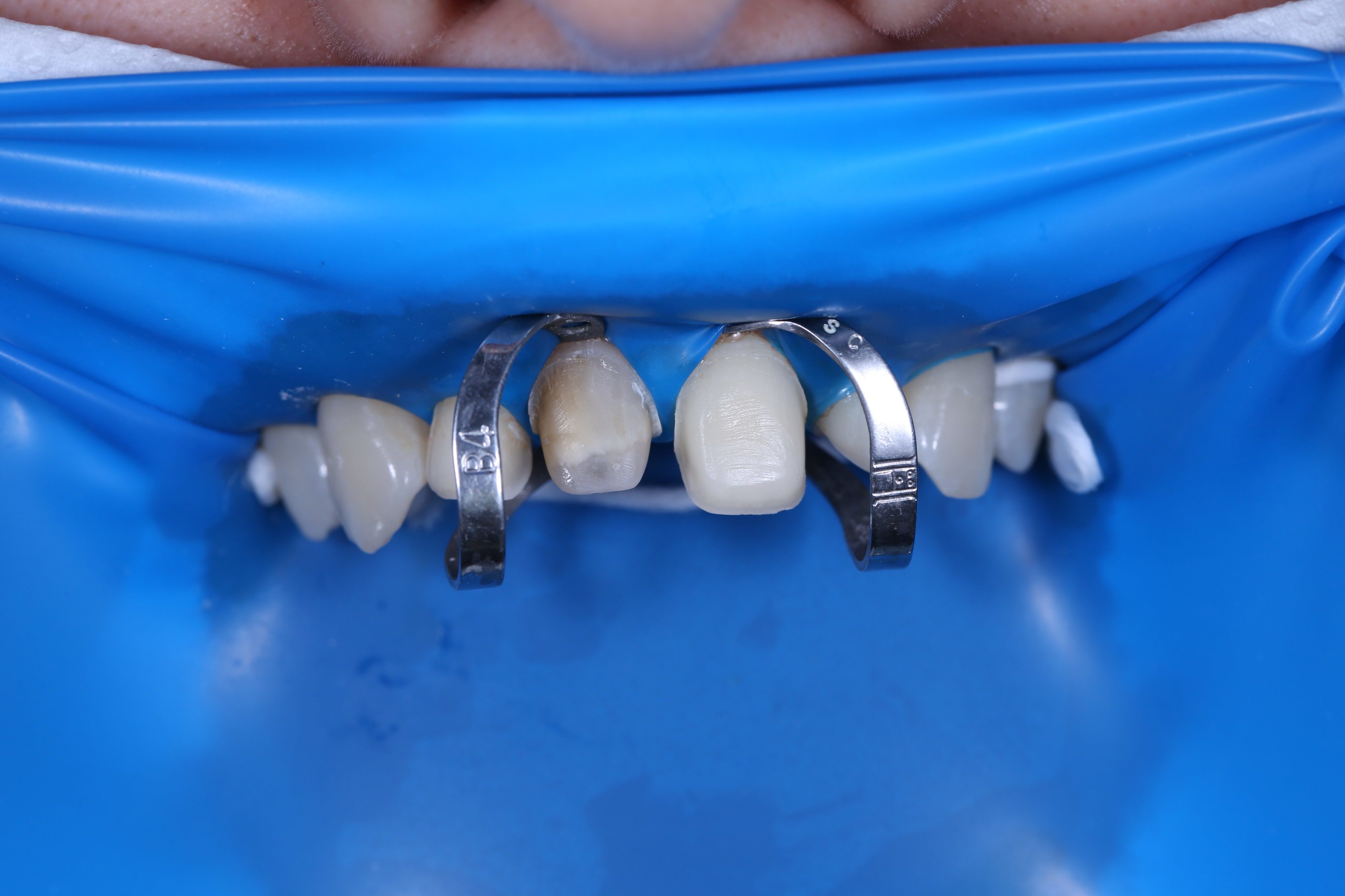 Лікування карієсу під мікроскопом