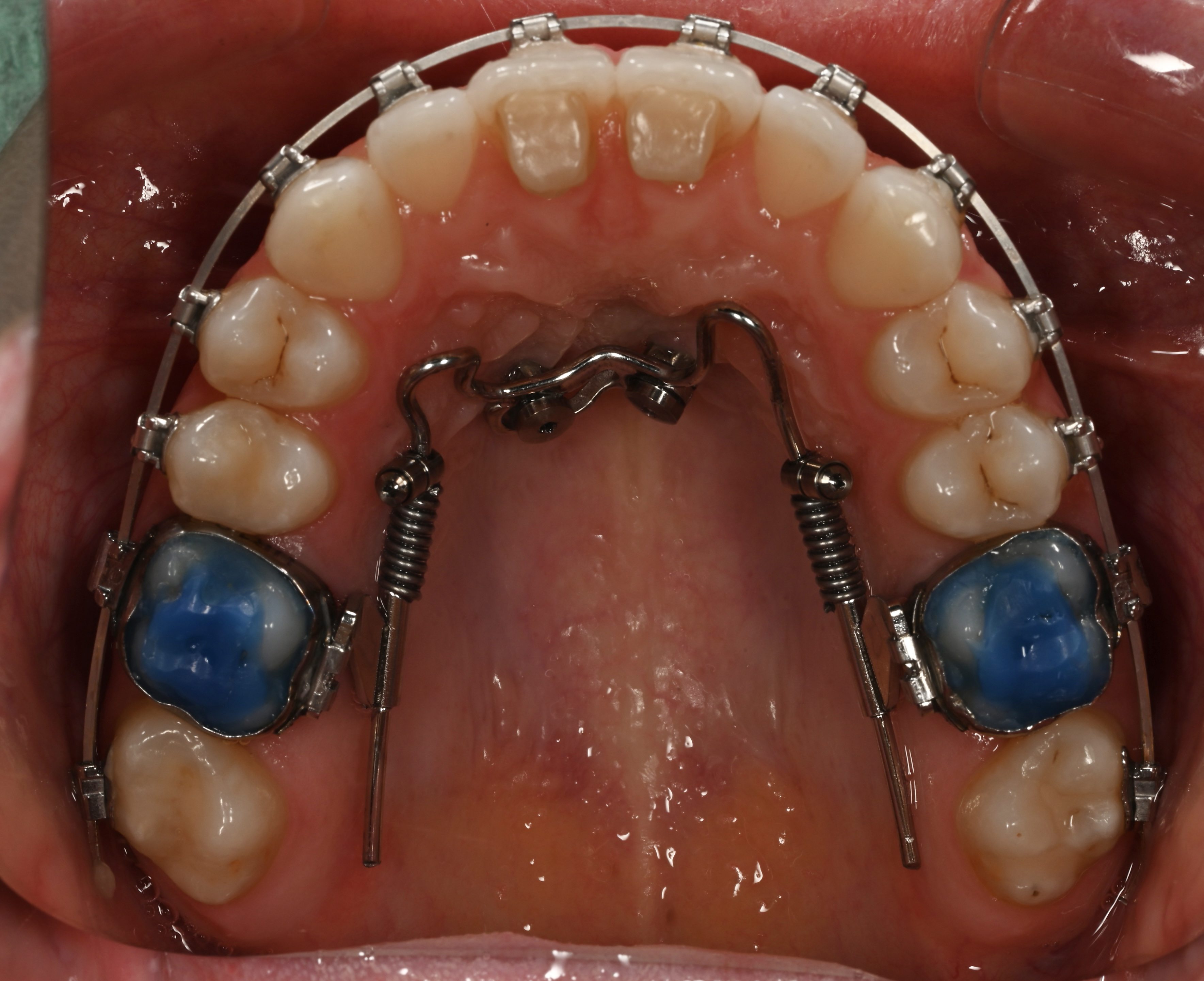 Ортодонтичні апарати