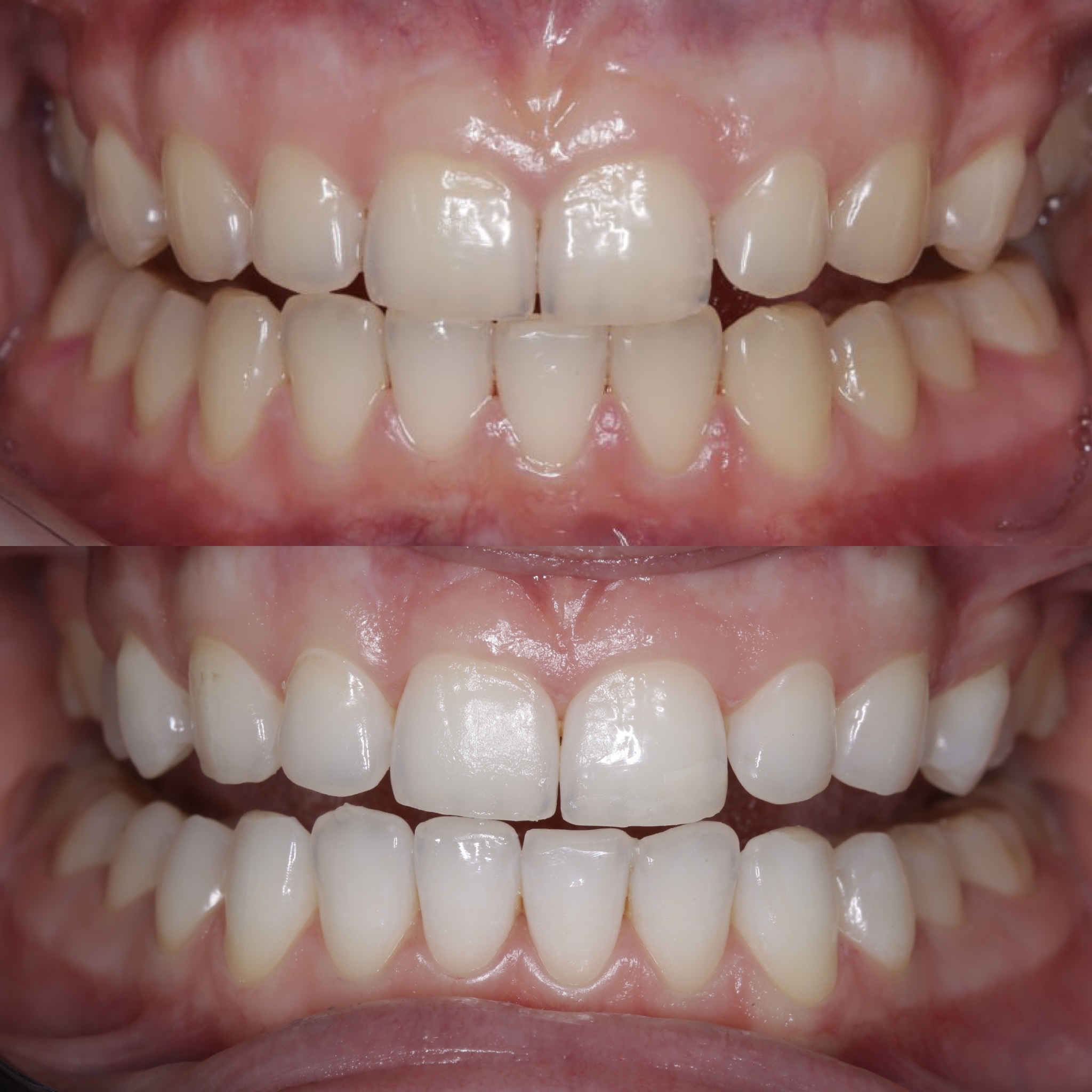 Апаратне відбілювання системою Beyond